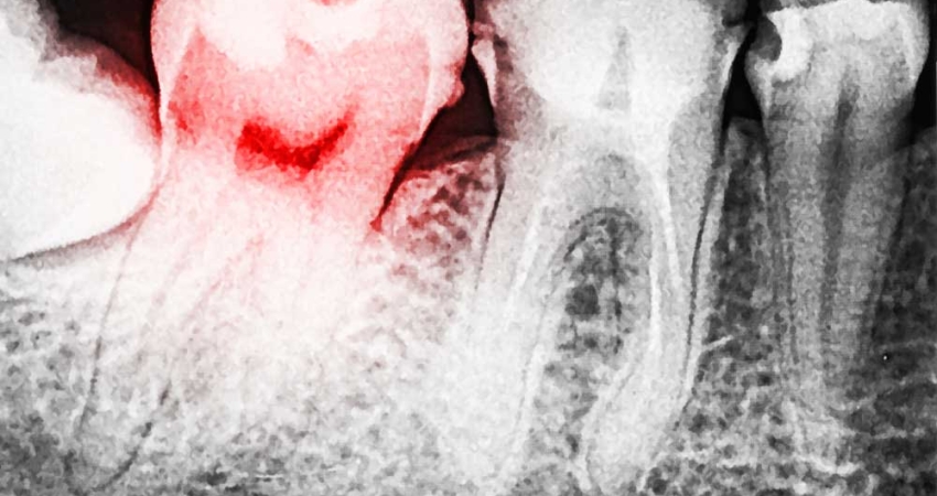 Treatment Of Dental Caries Radixdent